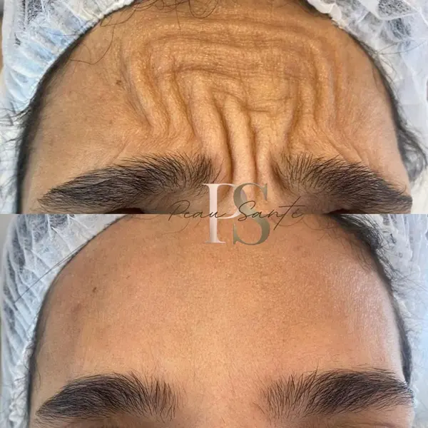 Antes e Depois - Região da Glabela