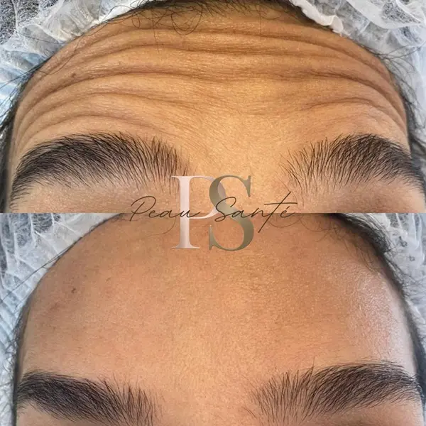 Antes e Depois - Linhas Frontais