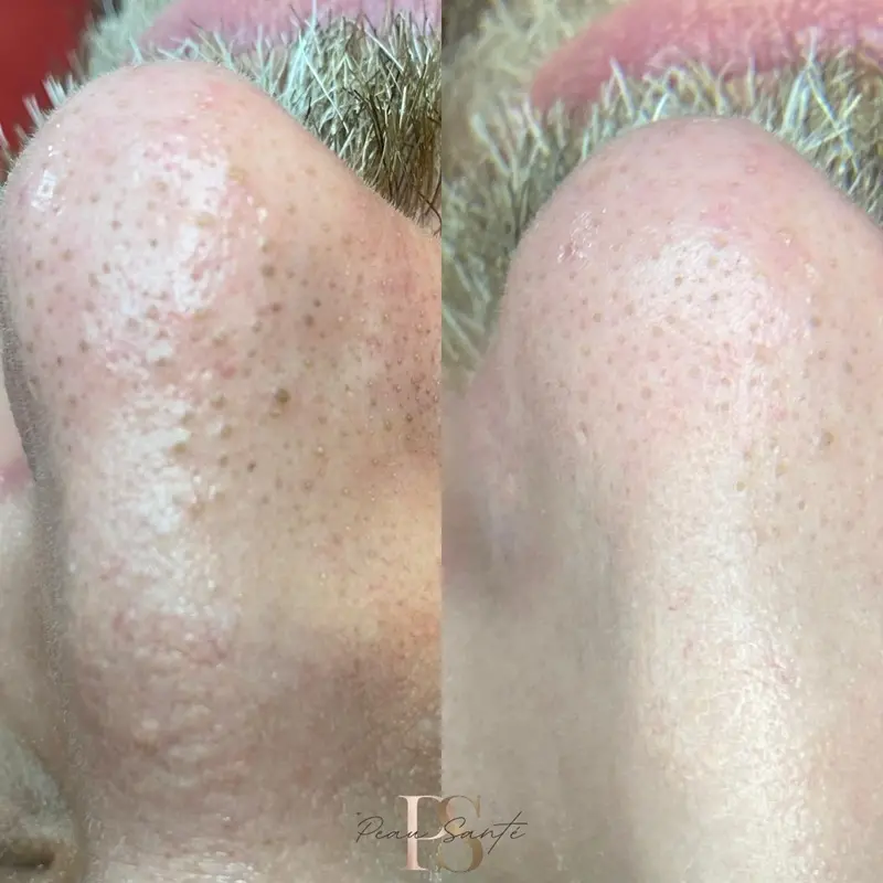 Antes e Depois - Remoção de Cravos